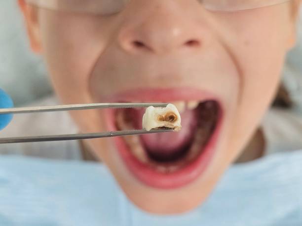 Best Dental Abscess Treatment in New Plymouth, ID